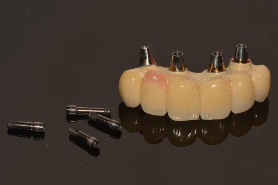 Dental Implants in Amritsar