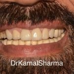 Renewing Radiance: Restoring Broken and Discolored Teeth to a Brilliant Smile at Dr. Kamal’s Smile Studio