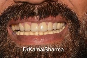 Read more about the article Renewing Radiance: Restoring Broken and Discolored Teeth to a Brilliant Smile at Dr. Kamal’s Smile Studio