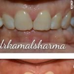 Transformative Smiles: Resolving Deep Bite and Discoloration for a Brighter, Confident Smile at Dr. Kamal’s Smile Studio