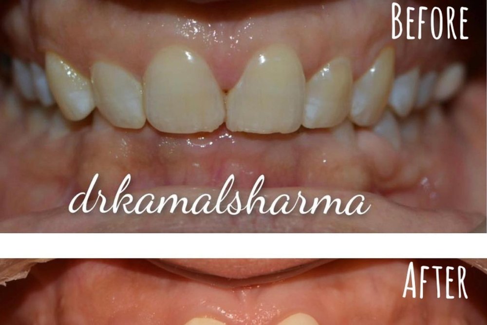 Read more about the article Transformative Smiles: Resolving Deep Bite and Discoloration for a Brighter, Confident Smile at Dr. Kamal’s Smile Studio