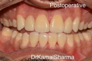 Read more about the article Space to Grace: Veneers Unveil a Transformed Smile at Dr. Kamal’s Smile Studio