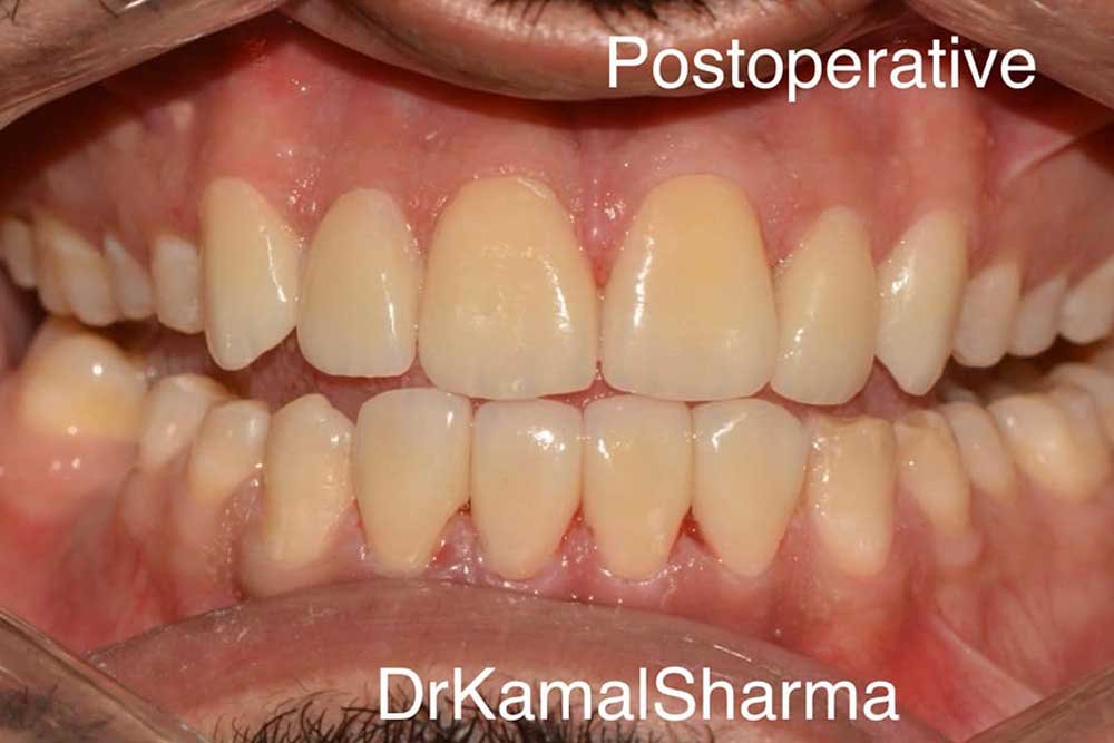 Before-and-after image showcasing a smile transformed with veneers at Dr. Kamal's Smile Studio. Gaps are closed, revealing a seamless, confident result.