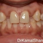 Natural Harmony Restored: Zircad Crowns Transform Smiles with Missing Lateral Incisors at Dr. Kamal’s Smile Studio