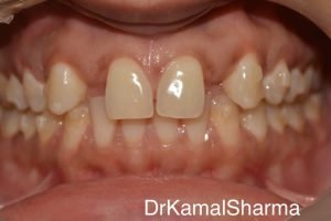Read more about the article Natural Harmony Restored: Zircad Crowns Transform Smiles with Missing Lateral Incisors at Dr. Kamal’s Smile Studio