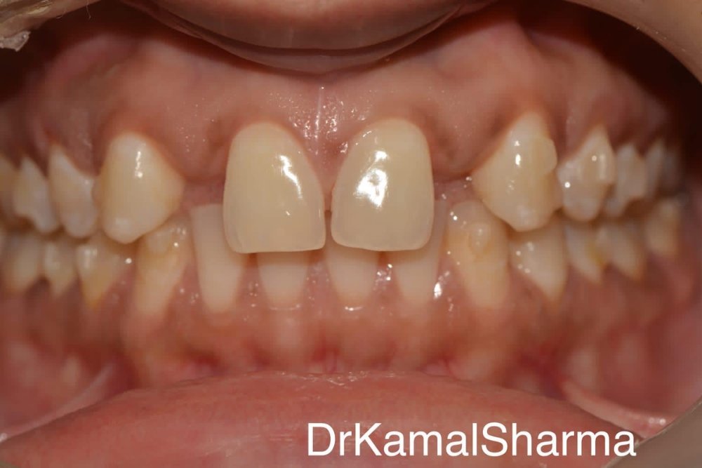Aesthetic and functional transformation with Zircad crowns at Dr. Kamal's Smile Studio, restoring missing lateral incisors for a radiant smile.