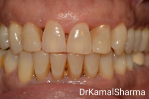 Read more about the article Transforming Smiles: A Journey to Erasing Black Triangles, Spaces, and Attrition with Dr. Kamal’s Smile Studio