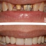 Reviving Radiance: Addressing Discolored Crowns and Aging Front Teeth at Dr. Kamal’s Smile Studio