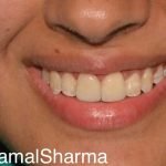 Revitalizing Smiles: Restoring Discolored and Ill-Restored Front Teeth at Dr. Kamal’s Smile Studio