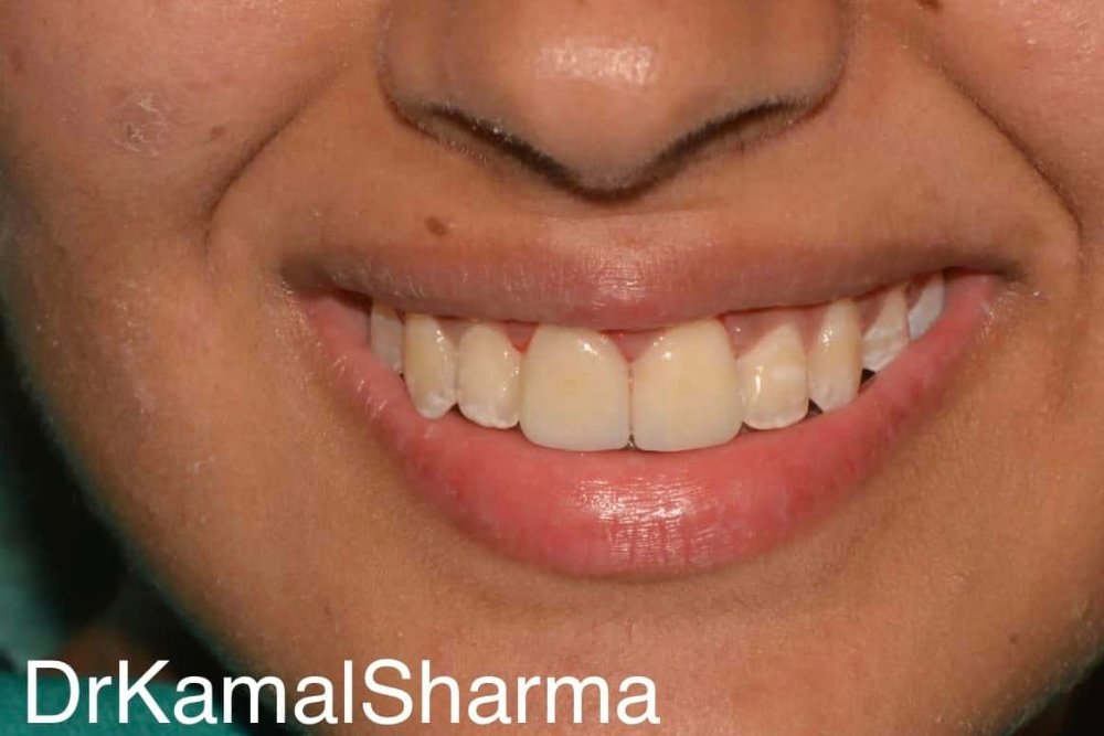 You are currently viewing Revitalizing Smiles: Restoring Discolored and Ill-Restored Front Teeth at Dr. Kamal’s Smile Studio
